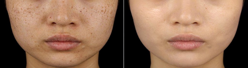 Before and after photos, case 1