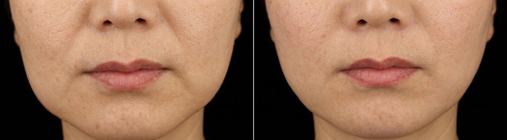Before and after photos, case 2